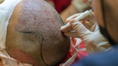 Hair Transplant Trypophobia Understanding the Intersection of Fear and Aesthetic Transformation with Smile Hair Clinic
