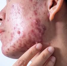 hormonal skin dermatologist